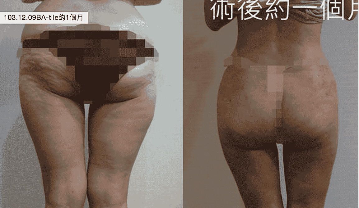 【雷射減脂】雷射減脂後曲線變美了，橘皮也大幅改善!